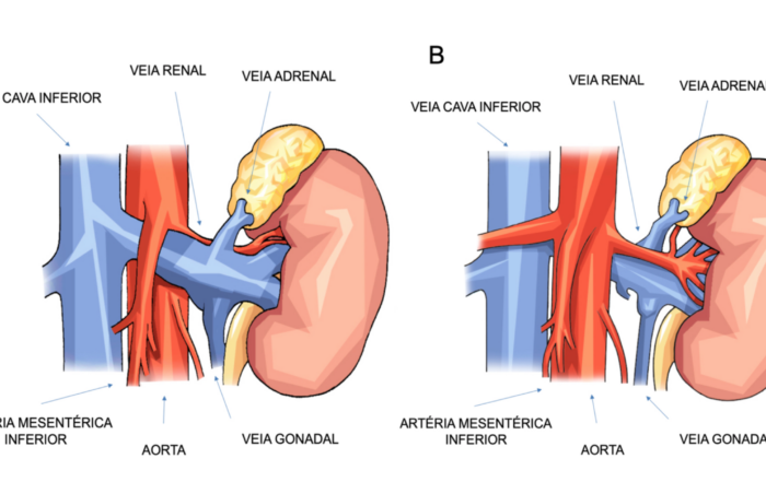 Figura 1 - Compressão de veia renal esquerda pela artéria mesentérica superior (A) e pela aorta, em veia renal retro-aórtica (B).