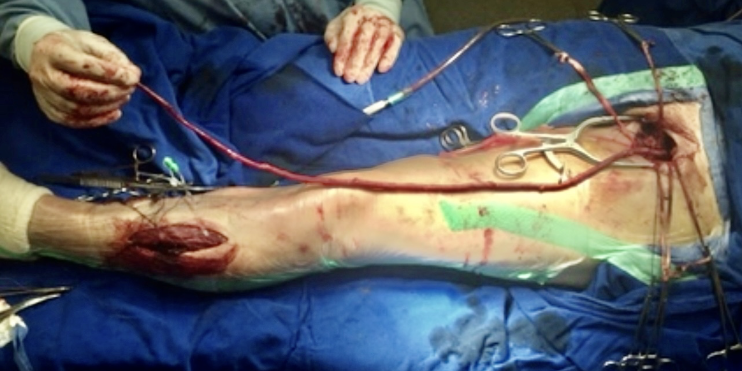 Restauração de fluxo por meio de enxerto com veia em membro inferior de doente com obstrução aguda de artéria de perna