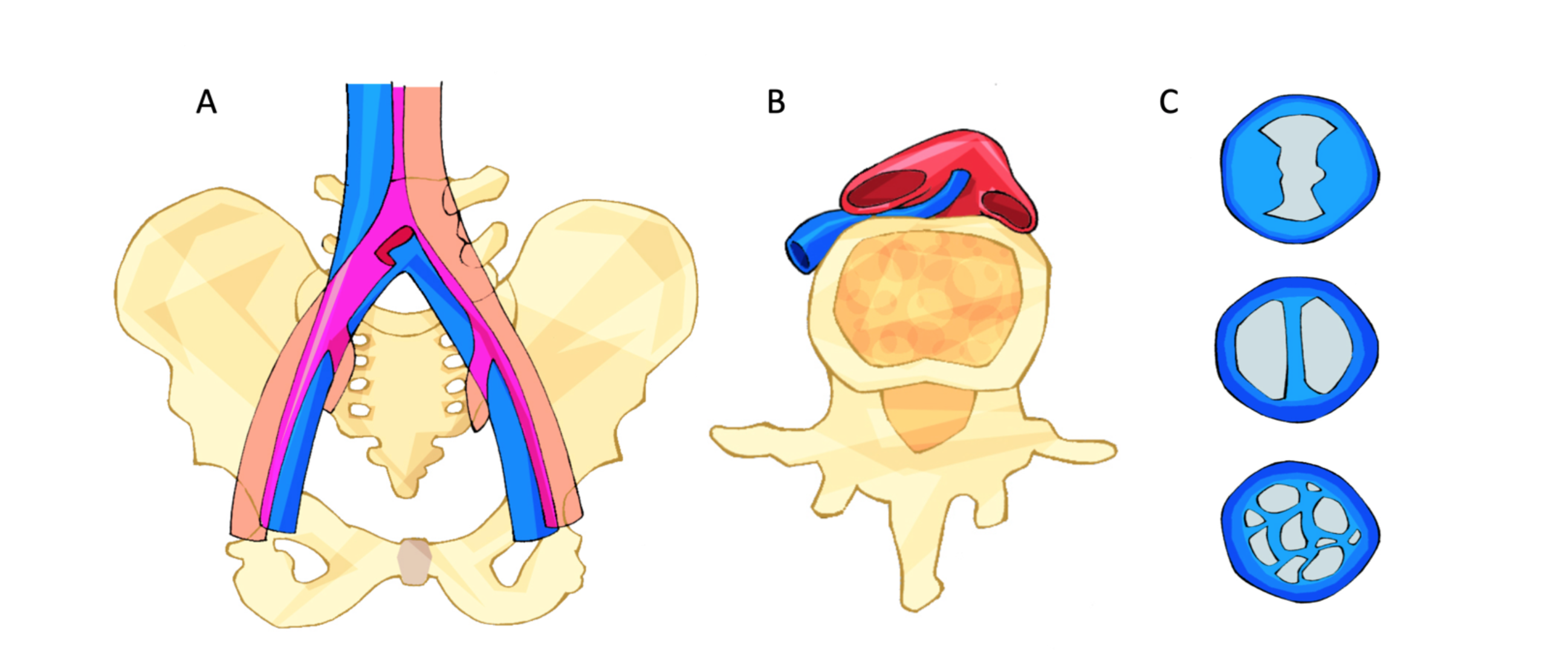 Figura 2 - Compressão de veia ilíaca comum esquerda por artéria ilíaca comum direita sobre coluna vertebral (A e B). Presença de obstruções endoluminais (espora, trave, membranas). 