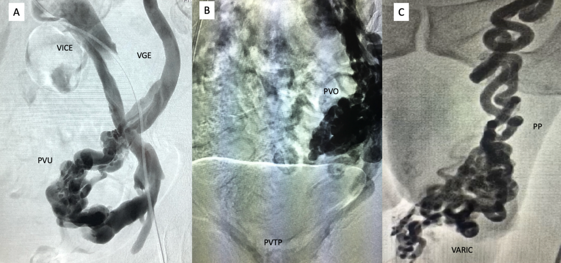 Figura 3 - Venografia por subtração digital demonstrando (A): refluxo em veia gonodal esquerda (VGE), no plexo venoso uterino (PVU), e na veia ilíaca comum esquerda (VICE); (B): Refluxo em veia gonadal, em plexo venoso ovariano (PVO) e plexo venoso trans-púbico (PVTP); (C): refluxo em veia espermática, plexo pampiniforme (PP) esquerdo. 