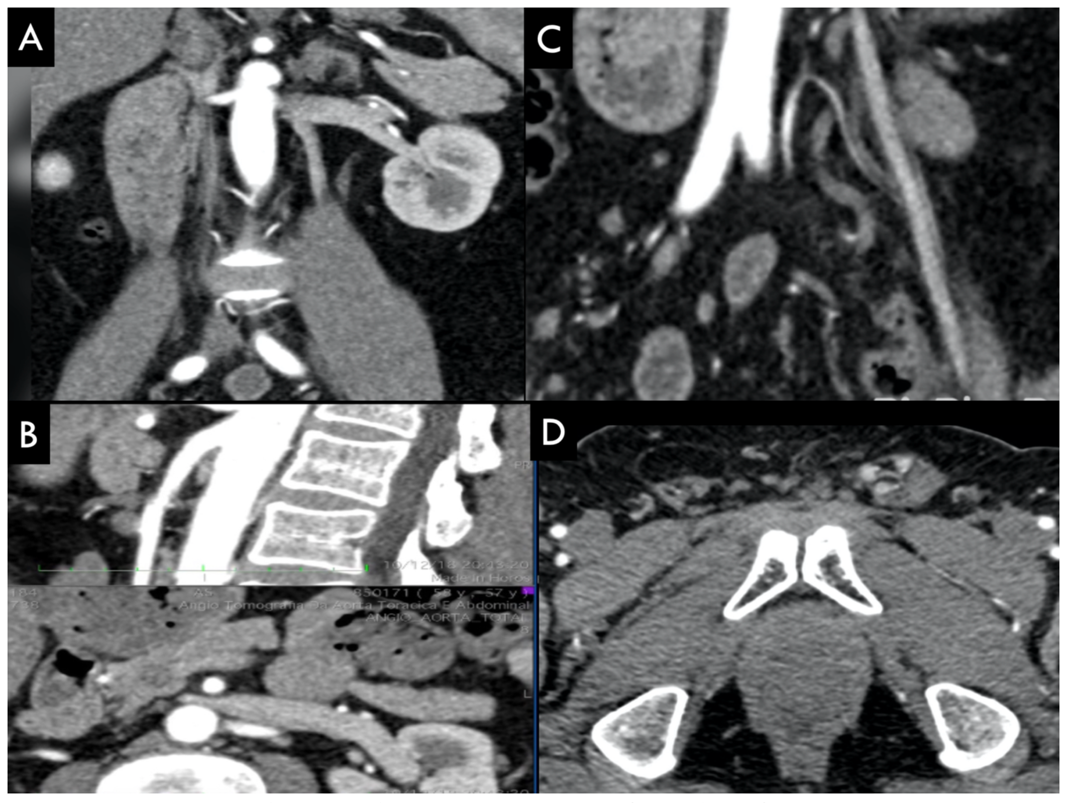 Figura 3 - Venografia por subtração digital demonstrando (A): refluxo em veia gonodal esquerda (VGE), no plexo venoso uterino (PVU), e na veia ilíaca comum esquerda (VICE); (B): Refluxo em veia gonadal, em plexo venoso ovariano (PVO) e plexo venoso trans-púbico (PVTP); (C): refluxo em veia espermática, plexo pampiniforme (PP) esquerdo. 