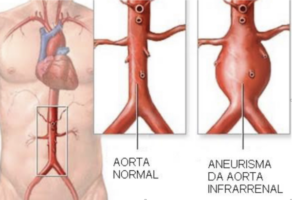 Aneurisma da Aorta Abdominal (AAA) – SBACVSP