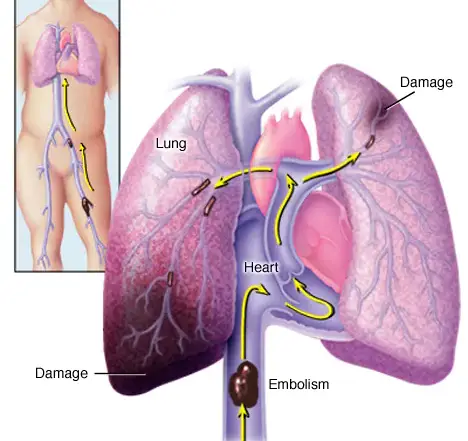 Embolia Pulmonar – SBACVSP